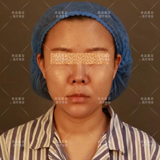 王绍国面部脂肪加减法果听说很六?来看这个案例!