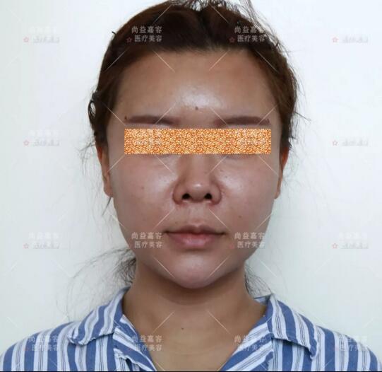王绍国面部脂肪加减法果听说很六?来看这个案例!