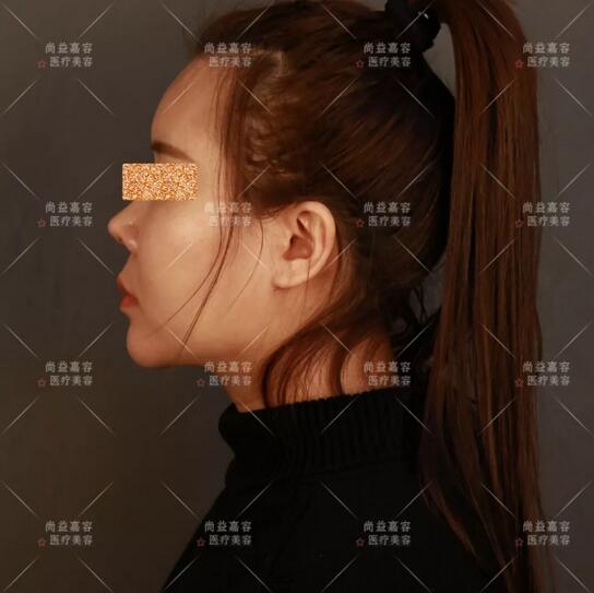 王绍国面部脂肪加减法果听说很六?来看这个案例!