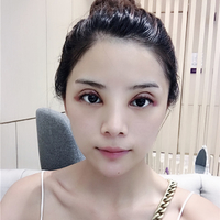 昆山百达丽整形医院沈国雄院长做双眼皮果好吗?在线求解~~~