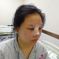 倪彬院长软骨隆鼻案例流出，并附上前后对比图展示