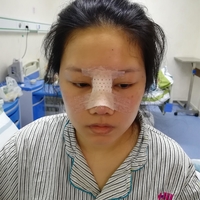 倪彬院长软骨隆鼻案例流出，并附上前后对比图展示