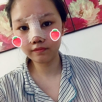 倪彬院长软骨隆鼻案例流出，并附上前后对比图展示