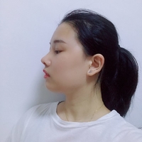 倪彬院长软骨隆鼻案例流出，并附上前后对比图展示
