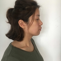 唐振利做鼻子怎么样?唐振利案例分享