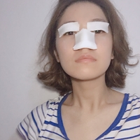 唐振利做鼻子怎么样?唐振利案例分享