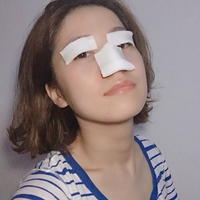 唐振利做鼻子怎么样?唐振利案例分享