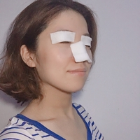 唐振利做鼻子怎么样?唐振利案例分享