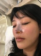 胡凯博士隆鼻案例对比分享：网红鼻一套下来3万左右 width=