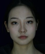 俞良钢V-Line长曲线下颌角案例对比图分享：168天男盆友亲自照料 width=