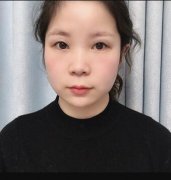 金永焕韩式三点定位双眼皮对比图：1-17天的恢复变化 width=