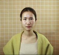 南昌鹏爱整形美容医院开眼角塑型成形案例分享：桃花眼 width=