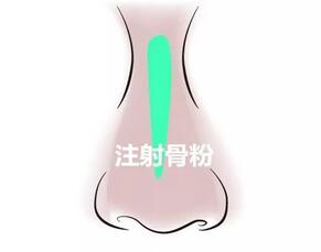 巫文云人工骨粉注射隆鼻修复全纪录，快来围观！