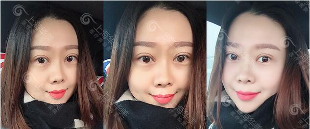 杨亚益park法割双眼皮案例分享~