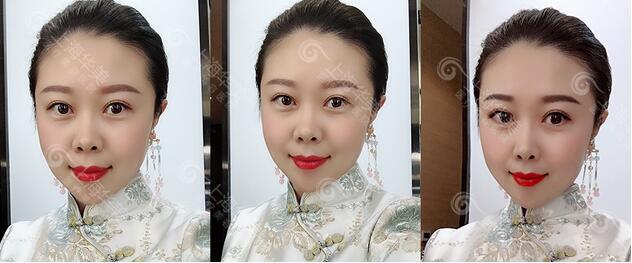 杨亚益park法割双眼皮案例分享~