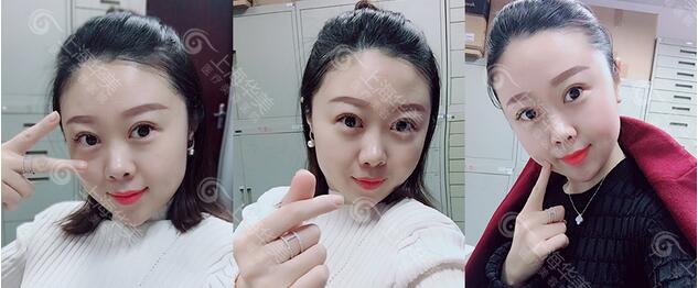 杨亚益park法割双眼皮案例分享~