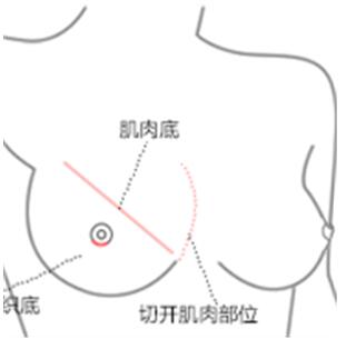 内窥镜德国vizaar威萨取奥美定全程详细记录，果很不错~