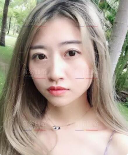 首尔丽格崔荣达下颌角切除+颧骨内推+祛除颊脂垫案例分享~