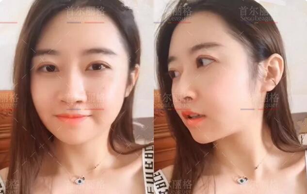 首尔丽格崔荣达下颌角切除+颧骨内推+祛除颊脂垫案例分享~