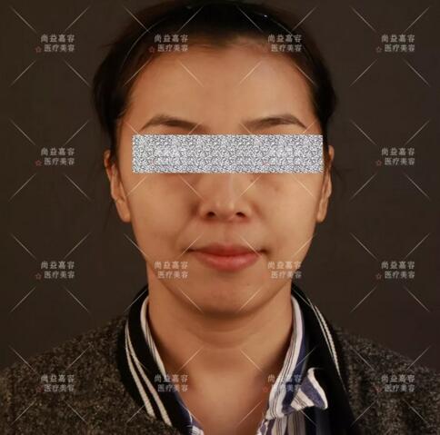王绍国讲述给患者做多方面部脂肪填充来龙去脉~