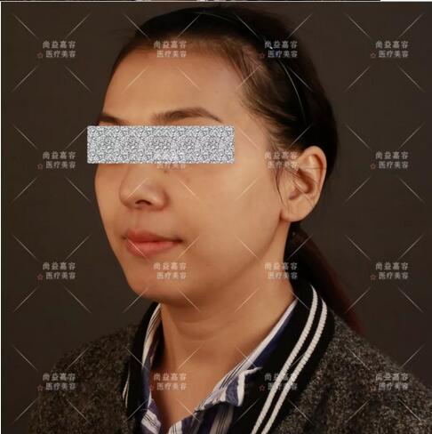 王绍国讲述给患者做多方面部脂肪填充来龙去脉~