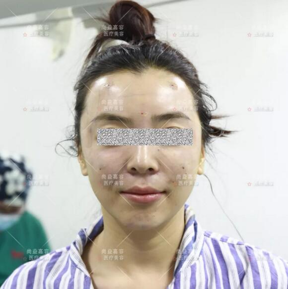 王绍国讲述给患者做多方面部脂肪填充来龙去脉~