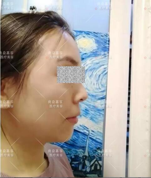 王绍国讲述给患者做多方面部脂肪填充来龙去脉~