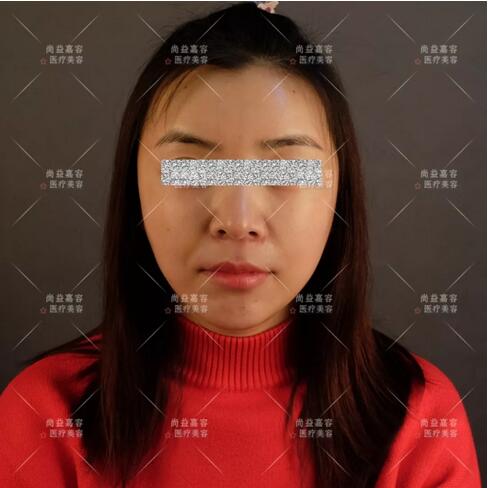 王绍国讲述给患者做多方面部脂肪填充来龙去脉~