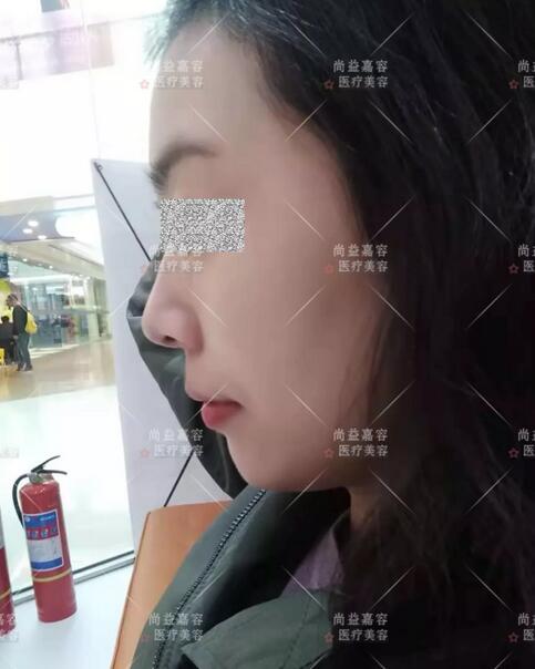 王绍国讲述给患者做多方面部脂肪填充来龙去脉~