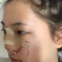 武汉伽美医疗美容医院技术如何?这鼻子已随我征战二十余载