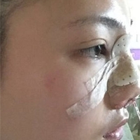 武汉伽美医疗美容医院技术如何?这鼻子已随我征战二十余载