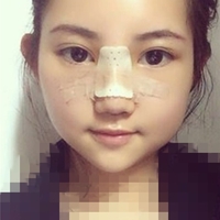 武汉伽美医疗美容医院技术如何?这鼻子已随我征战二十余载