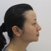 下巴吸脂恢复过程图片欣赏，前后变化真的是天差地别 width=