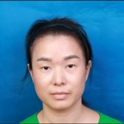 全切去皮去脂双眼皮多久恢复?术后果图展示 width=