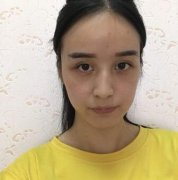 谷琪大西北祛眼袋对比图分享：眼袋卧蚕傻傻分不清~ width=