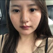 宋瑜三次激光祛斑对比：皮肤白嫩宛如婴儿肌肤 width=