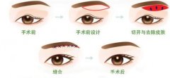 上睑下垂矫正后遗症有哪些喃? width=