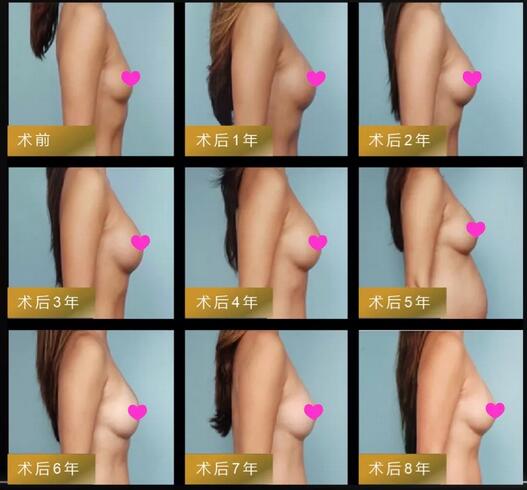 重庆美莱0元丰胸丨12星座维密胸模免费招募火热进行中！