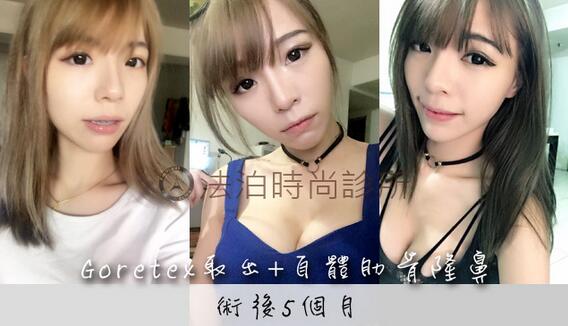 陈付国做鼻子好贵?贵自有它贵的理由!我用我的亲身经历来给大家阐释吧!