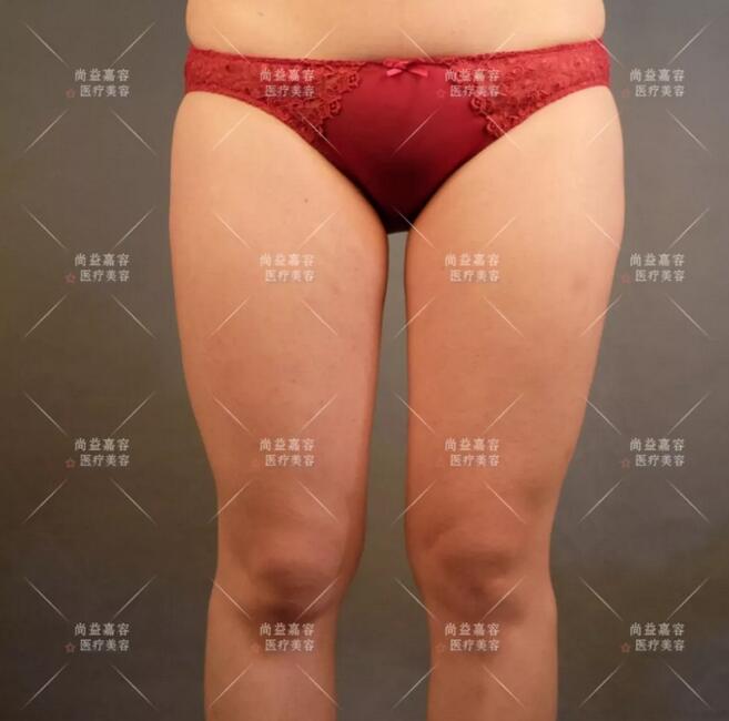 【常冬青大腿吸脂案例】