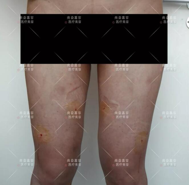 【常冬青大腿吸脂案例】
