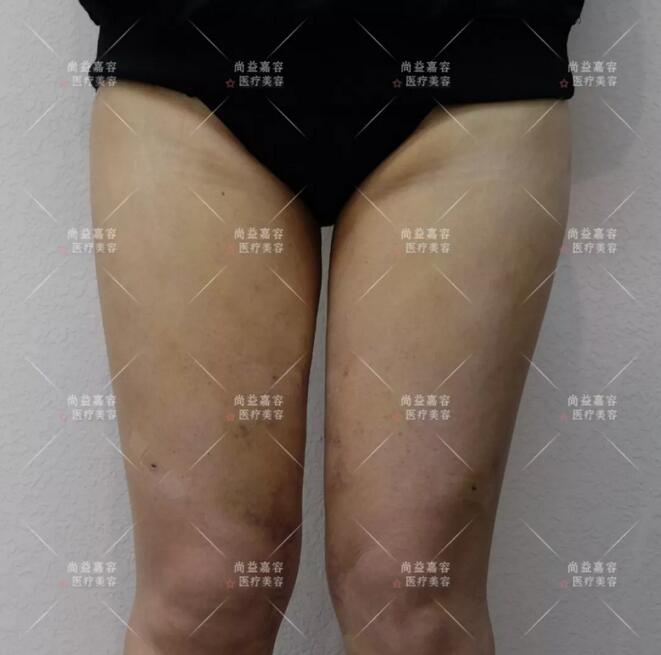 【常冬青大腿吸脂案例】
