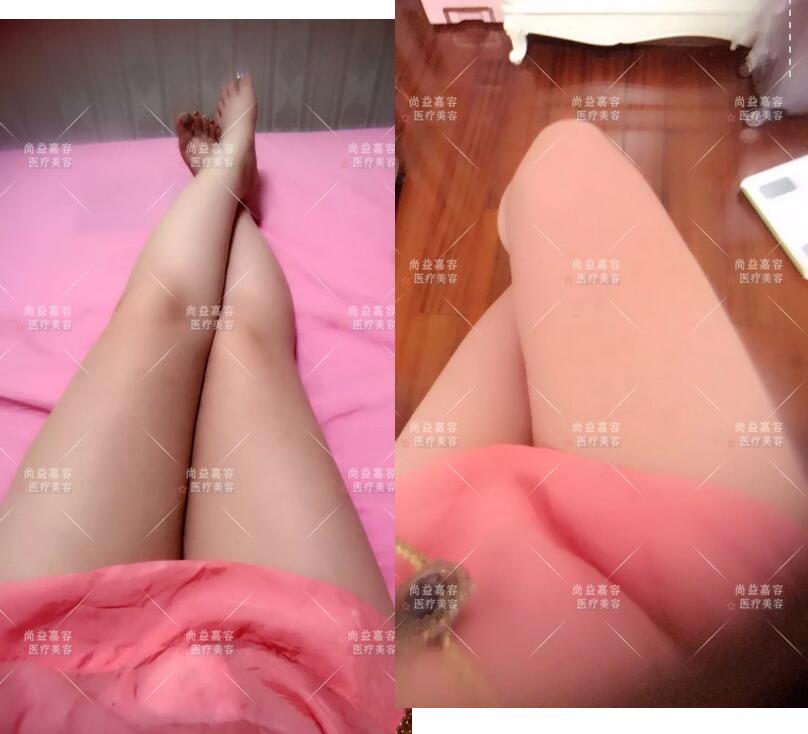 【常冬青大腿吸脂案例】