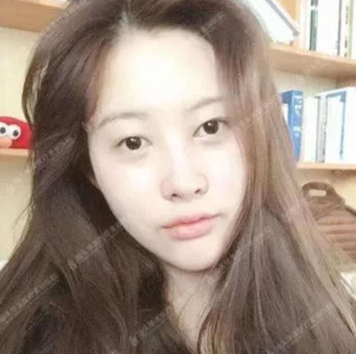吸雕双眼皮真实案例昏享，我想值得你一看！