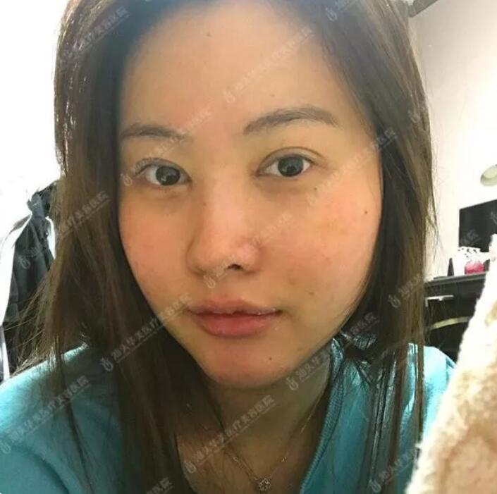 吸雕双眼皮真实案例昏享，我想值得你一看！