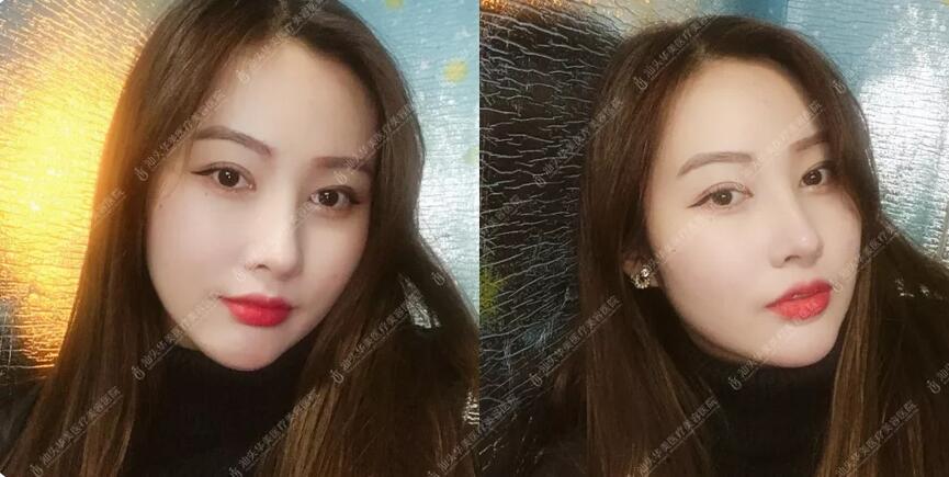 吸雕双眼皮真实案例昏享，我想值得你一看！