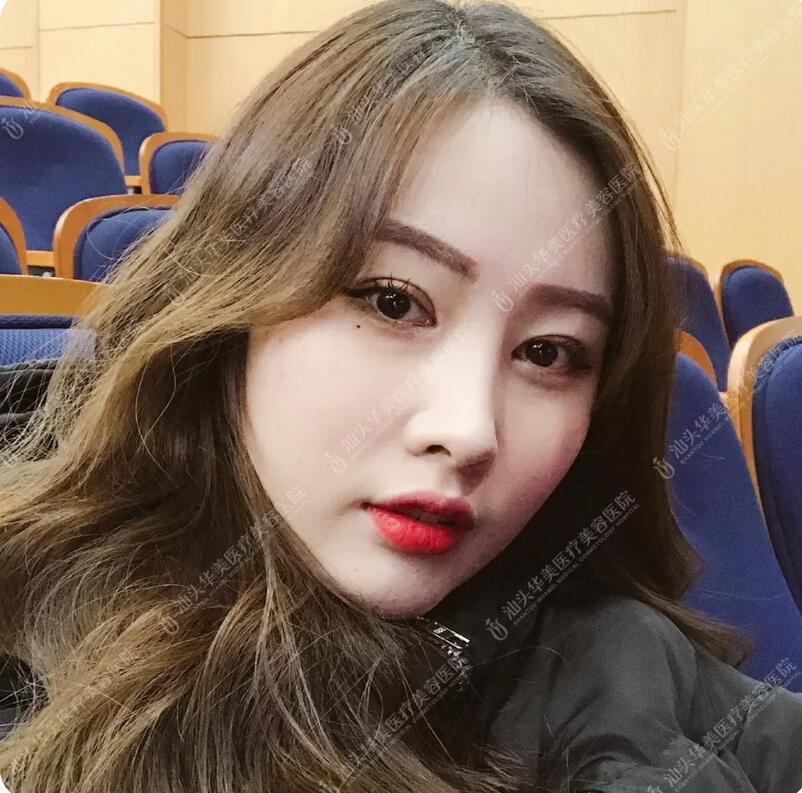 吸雕双眼皮真实案例昏享，我想值得你一看！