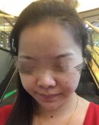 黑脸娃娃改良色素沉著果如何?明X不? width=