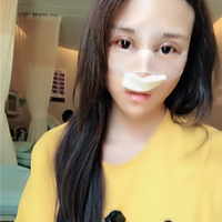 杜太超隆鼻失败修复技术真的好吗?我仿佛看见了希望
