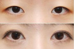 蒙古褶是什么?蒙古褶要怎么去除? width=